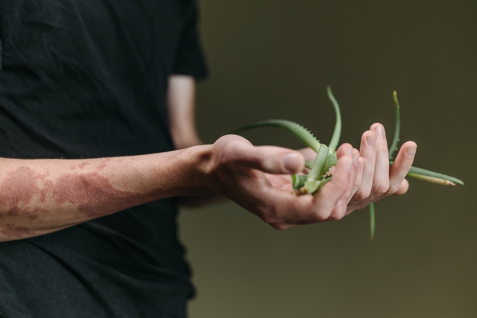 ¿Cómo eliminar cicatrices con aloe vera? ¿Cómo eliminar cicatrices con aloe vera?